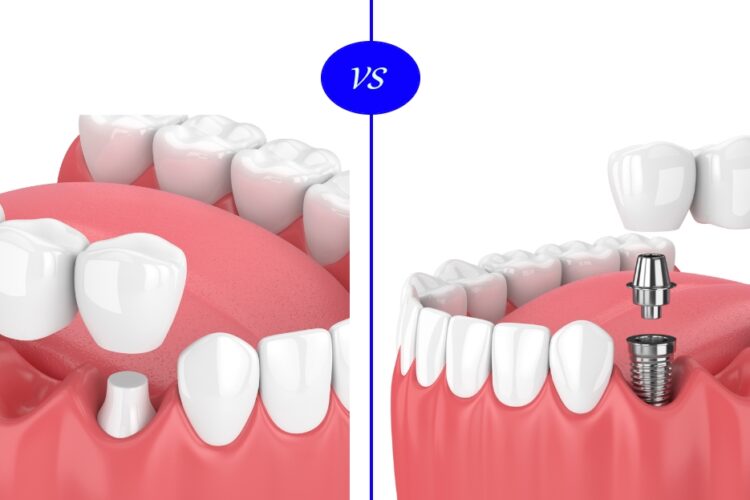 dental-implants-vs-dental-bridge