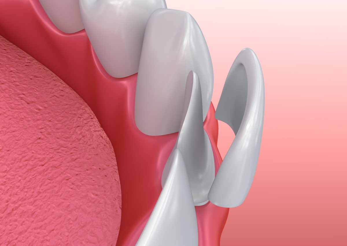 dental veneers magic smile